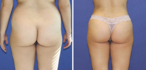 Before and after pictures of a patient who has undergone a Brazilian butt lift