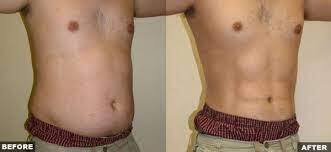 Liposuction For Men Before & After Photos