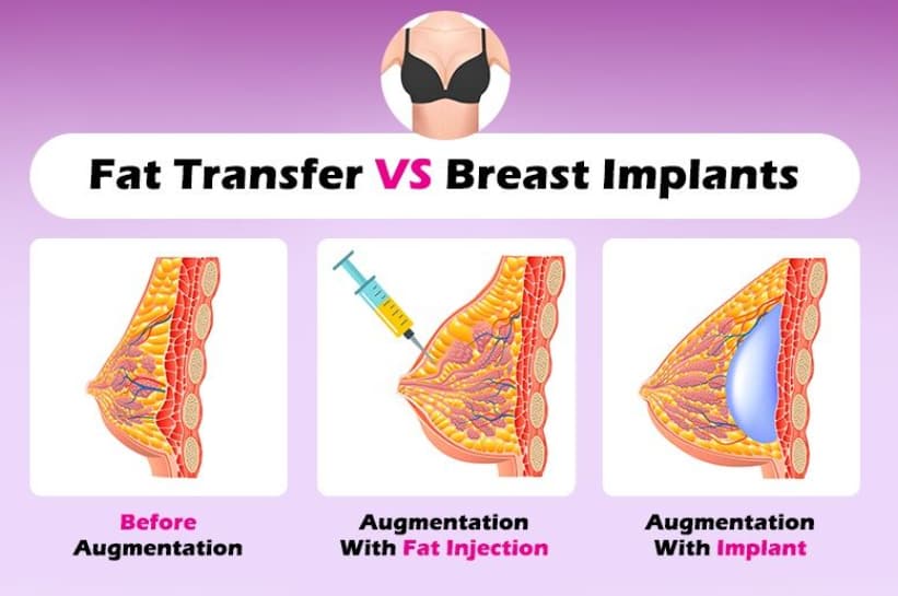 https://www.northtexasplasticsurgery.com/wp-content/uploads/2022/04/fat-transfer-vs-implants.jpg